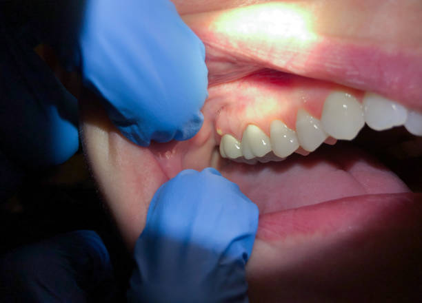 Best Emergency Treatment for Toothache in Westlake Vlage, IL